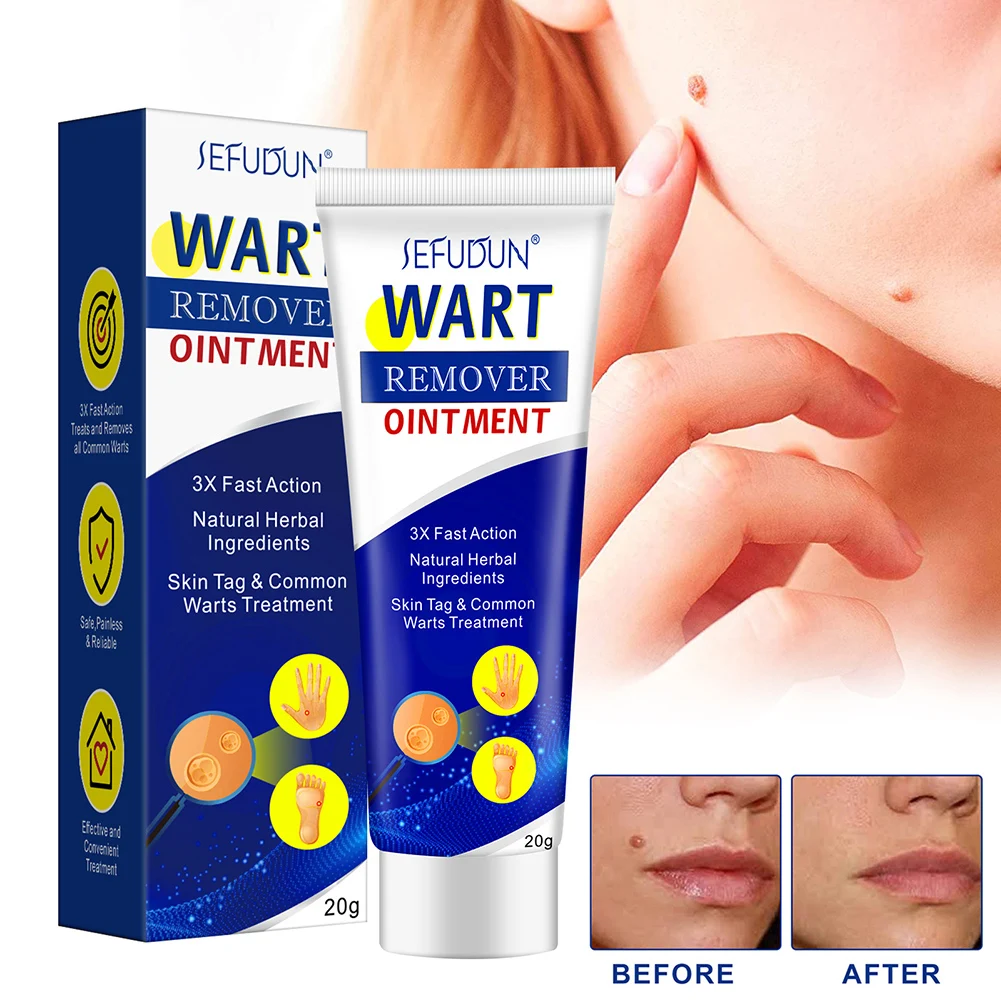Wart Remover Cream Fast Acting Safe Quickly Remove Skin Tags Wart Callus Natural Ingredients Skin Tag