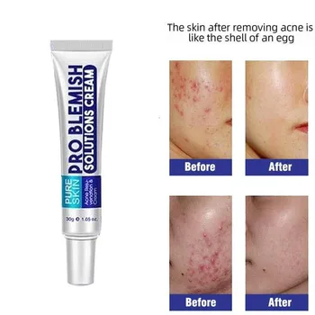 

Bioaqua 30g Acne Treatment Blackhead Remova Anti Acne Cream Oil Control Shrink Pores Acne Scar Remove Face Care Whitening