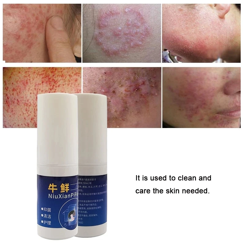Herbal Psoriasis Spray Is Suitable For Various Psoriasis And Eczema Skin Problem Patch Body Massage Antibacterial Cleansing Care