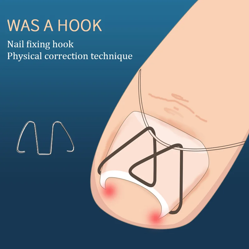 

Orthodontic correction of nails and nails in the meat