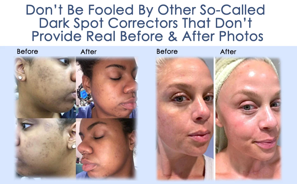 Dark Spot Corrector Remover For Face& Melasma Treatment Fade Cream- Contains Vitamin C, Salicylic Acid, Kojic Acid