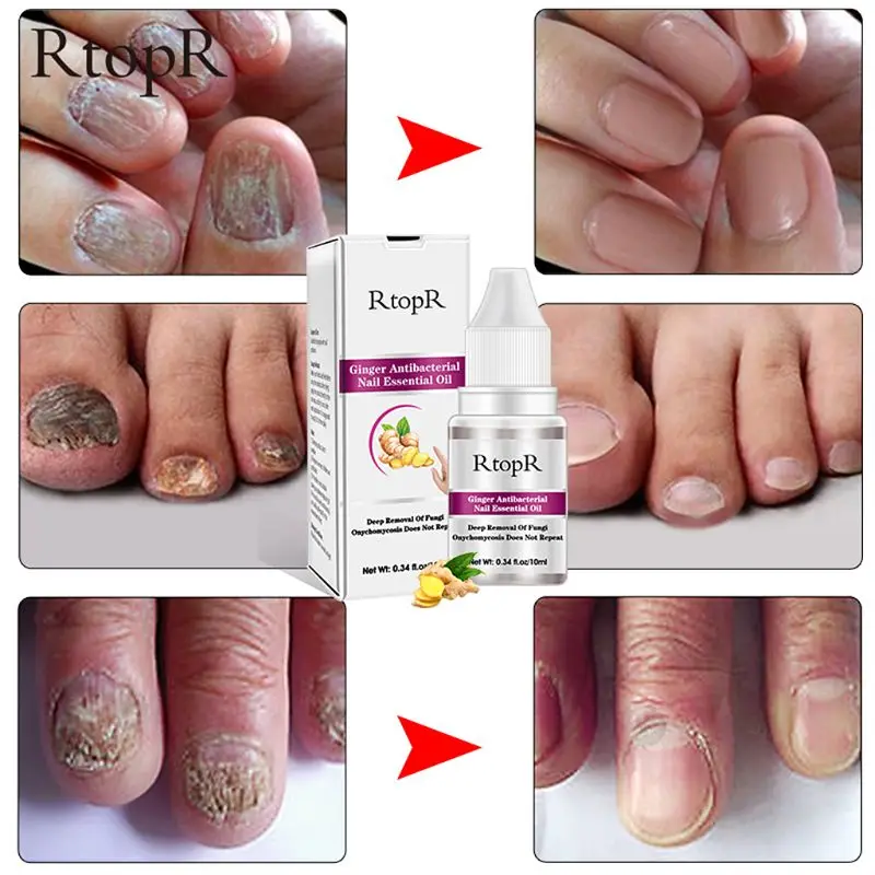 RtopR Ginger Antibacterial Nail Treatment Onychomycosis Paronychia Anti Fungal Nails Infection Toe Fungus Treatment 10ml M7DB