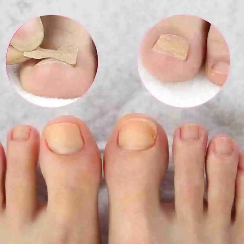 10pcs Ingrown Toenail Corrector Stickers Fingernail Toe Nail Corrector Patch Paronychia Inlays Treatment Care Pedicure Tools Hot