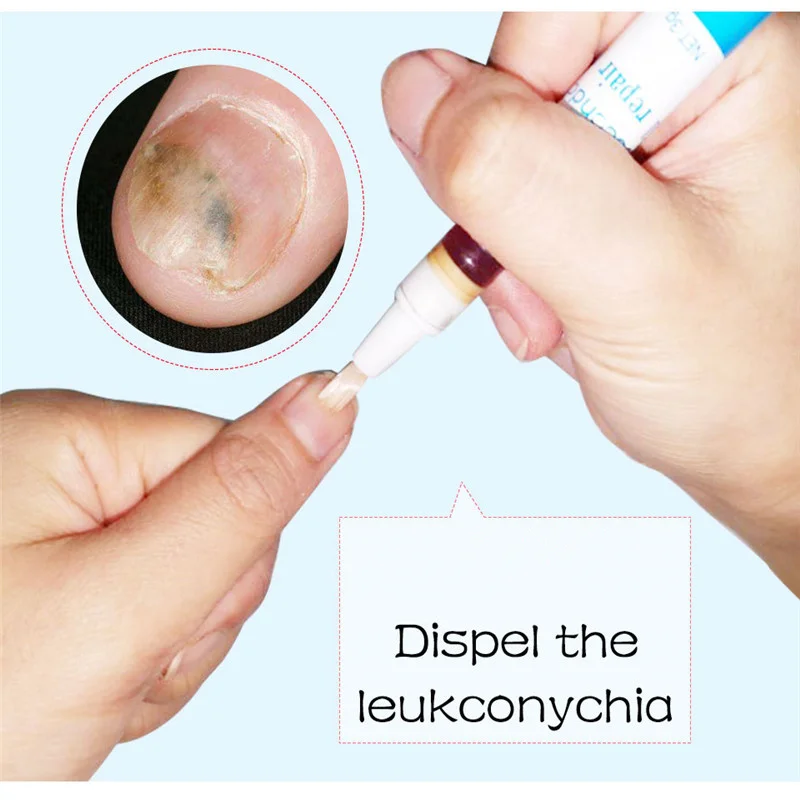 Анти грибок ногтей жидкость Leuconychia Degerming Pen Biofilm Ringworm фермент ремонт