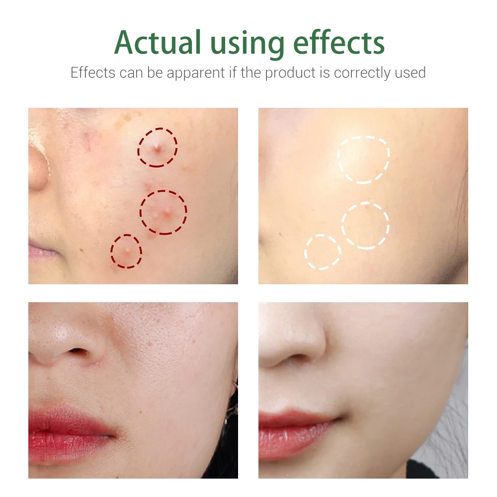 BREYLEE Facial Acne Treatment Cleanser Remove Blackhead Cleaner Shrink Pore Oil Control Cleansing Wash Mask Face Skin Care facial cleanser