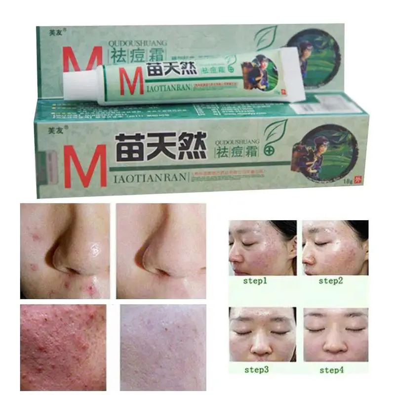 1 шт. Fuyou Miaotianran удаляет крем от акне бактерицидного удаления Клеща и увлажняет вашу кожу