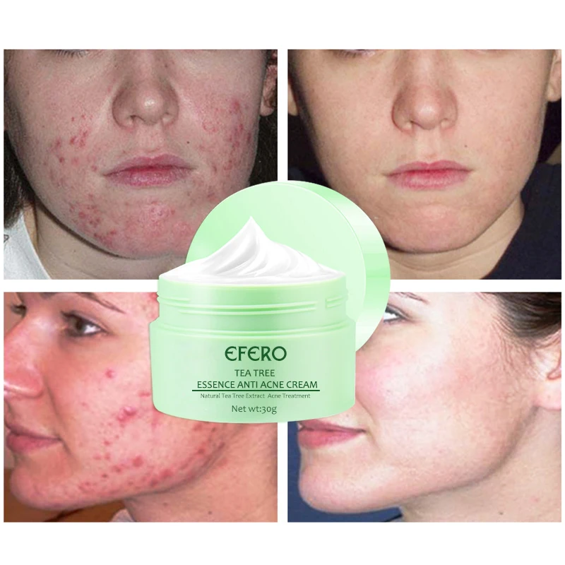 Whitening Face Cream Green Tea Extract Anti Acne Cream Collagen Eye Cream Dark Circle Whitening Hydrating 1 Whitening Face Cream Green Tea Extract Anti Acne Cream Collagen Eye Cream Dark Circle Whitening Hydrating 2