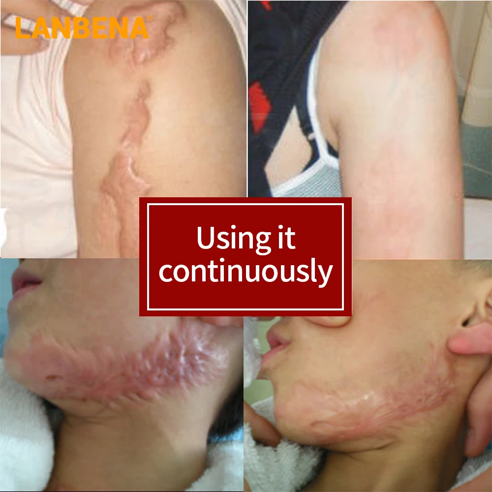 LANBENA Scar Removal Cream Acne Scar Stretch Marks Remover Face Cream Burn Skin Treatment Soothing Whitening 1 LANBENA Scar Removal Cream Acne Scar Stretch Marks Remover Face Cream Burn Skin Treatment Soothing Whitening 3