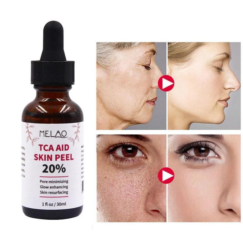 

30ml Tca Aid Skin Peel Trichloroaectic Acid Whitening Essence 20% Skin Peel Pore Minizing Wrinkles Spots Skin Care Face Serum