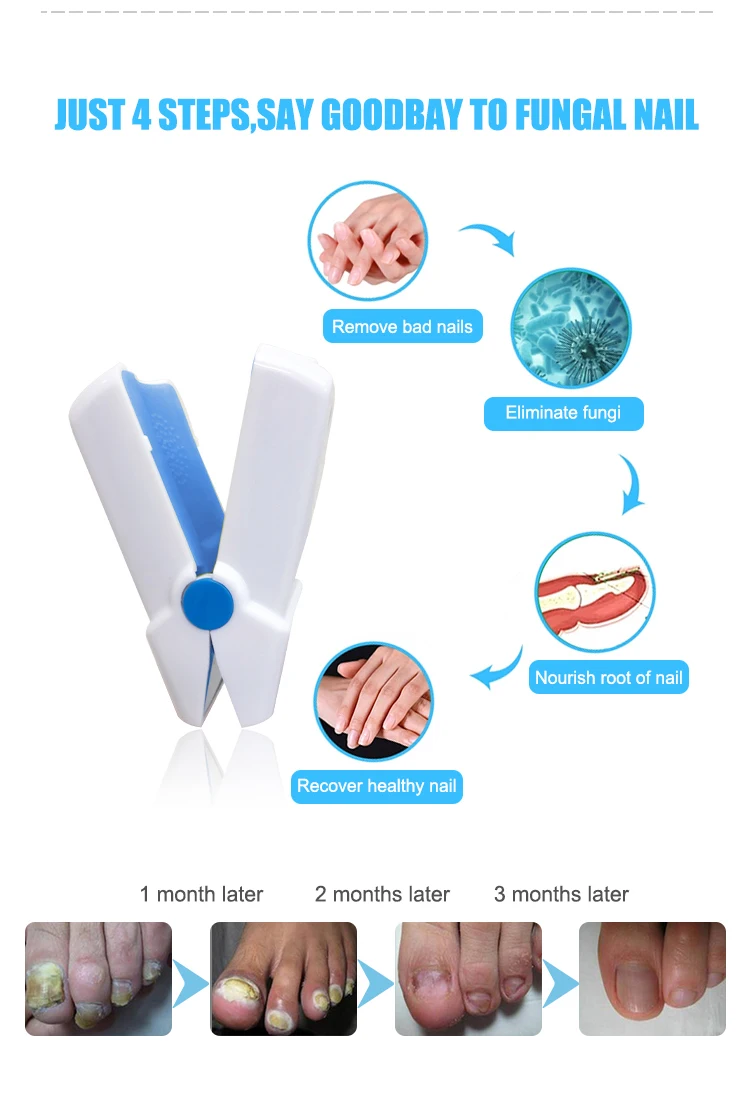 nail fungus laser device 8