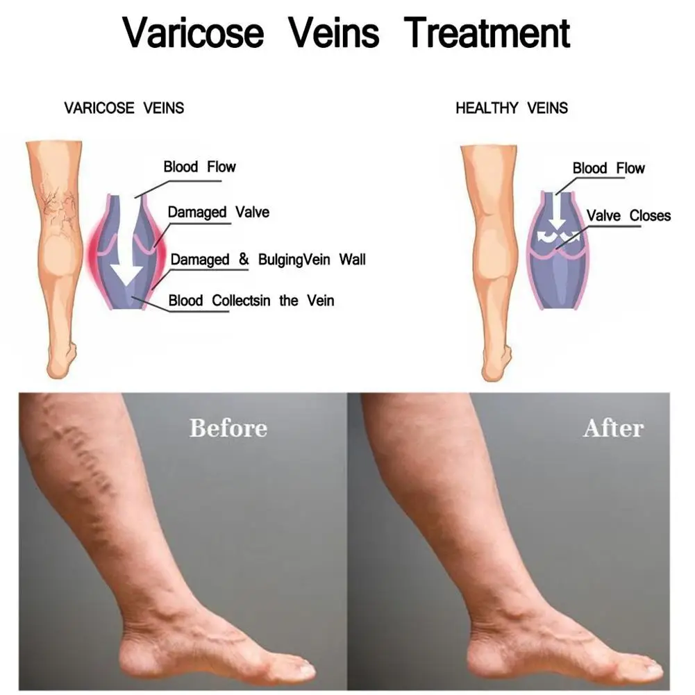 Полезное лечение Варикозного расширения вен крем эффективное лечение васкулит фалебит паук вены боль вариксия ангиит пластырь с узорами