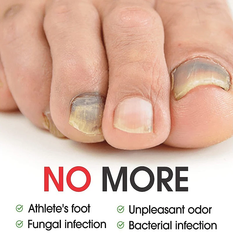 Nail Fungus Treatment Essence Serum Care Hand and Foot Care Removal Repair Gel Anti-infective Paronychia Onychomycosis