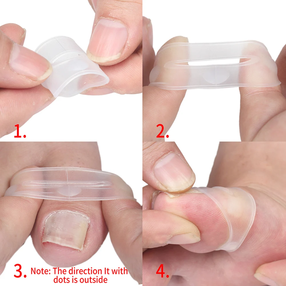 2pcs Silicone Ingrown Toenail Correcting Tool Pain Relief Paronychia Treatment Corrector Invisible Silicone Inlay Corrector Care