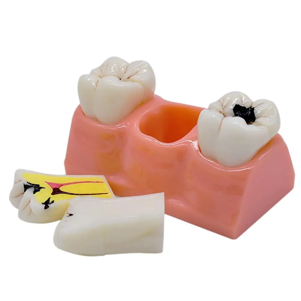  Dental teaching Model patien communication Dissected Caries Model Caries Decomposition Model Oral D - 4000402181013