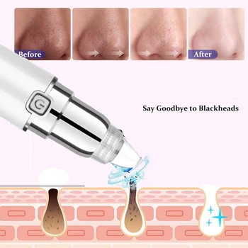 

Face Blackhead Removal Vacuum Cleaner-Battery Operated Pore Cleaner Blackhead Removal Tool with 4 Replaceable Suction Cups for B