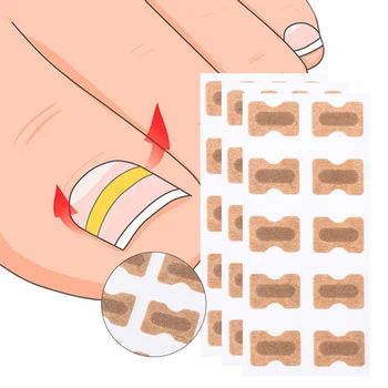 

New Ingrown Nail Correction Stickers Paronychia Treatment Recover Toe nail repair No glue needed Health care Pedicure Tools