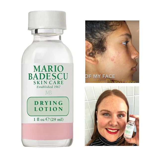 29ml efficace trattamento dell'acne Mario Badescu lozione essiccante 29ml  siero Anti Acne rimozione delle imperfezioni dei brufoli prodotti per la  cura della pelle - AliExpress