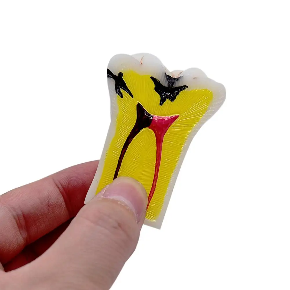  Dental teaching Model patien communication Dissected Caries Model Caries Decomposition Model Oral D - 4000402181013