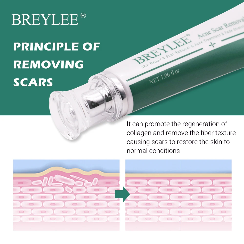 BREYLEE Acne Scar Removal Cream 30g Face Cream Skin Repair Skin Care Scar Acne Treatment Remove Stretch Marks Whitening Cream   (7)