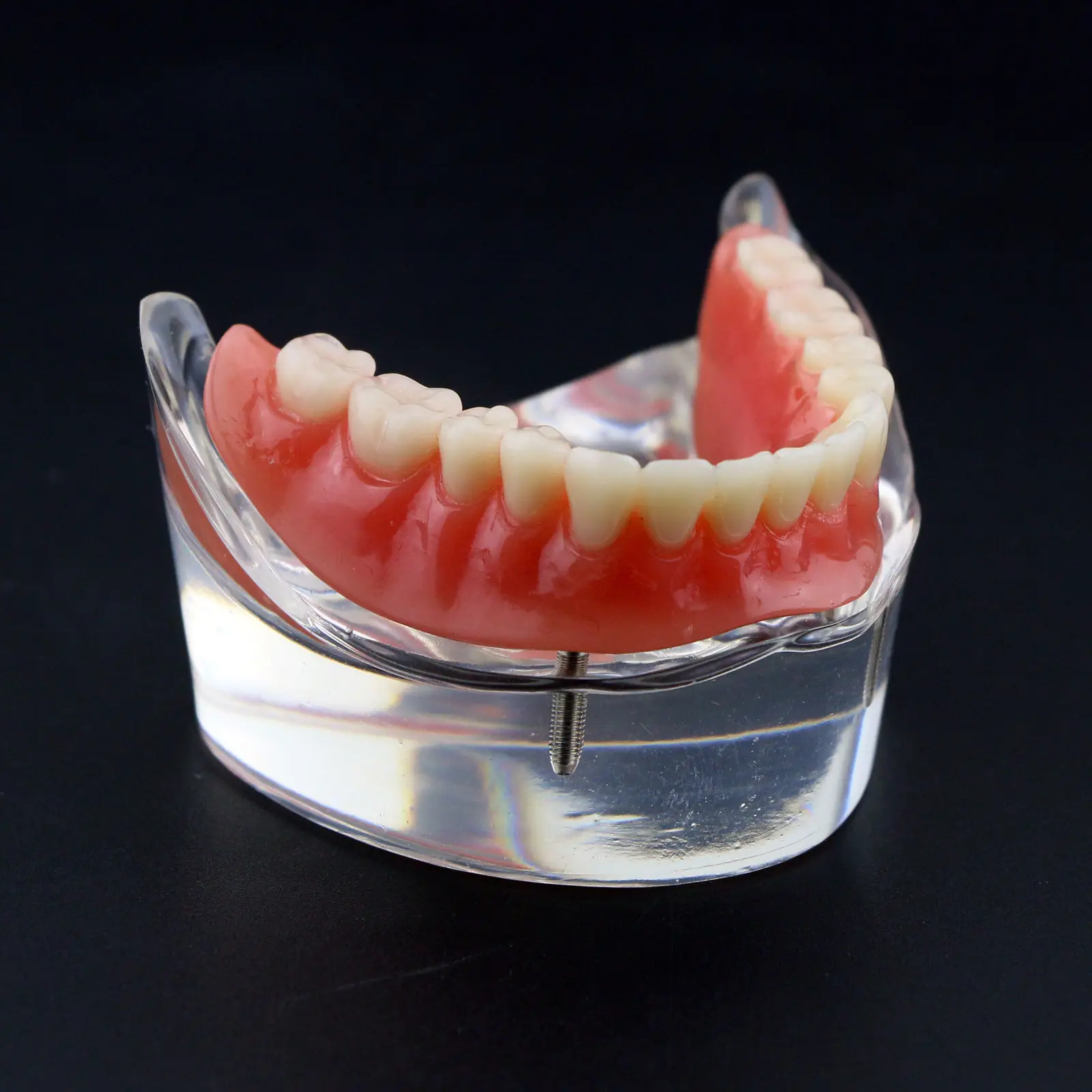 Стоматологическая Overdenture уступает с 2 имплантатами Demo модель исследования модель
