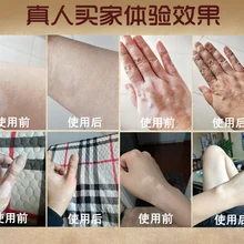 Лечение кожи белый пестрый витилиго набор