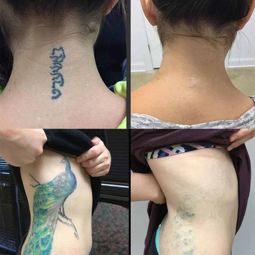 New Tattoo Accesories Safe Permanent Tattoo Removal Cream Tattoo Print Cleaning Cream Applicable on Most Parts of Body