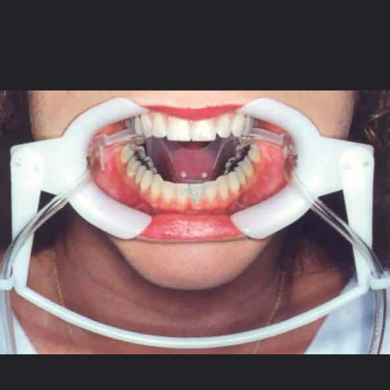 1 sztuk Dental zwijacz z sub ślina wewnątrzustna Lip Cheek zwijacz otwieracz do ust policzek rozwiń stomatologia Oral Dry Field 3 1 sztuk Dental zwijacz z sub ślina wewnątrzustna Lip Cheek zwijacz otwieracz do ust policzek rozwiń stomatologia Oral Dry Field 3