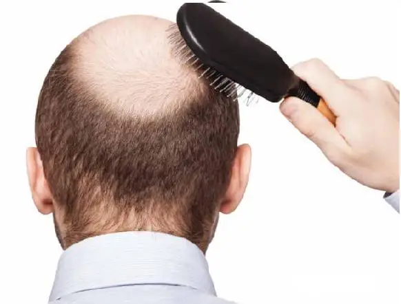 

99% pure minoxidil powder sulphate hair growth hair loss treatment, hair loss products,quality hair ,minoxidil hair Best quality