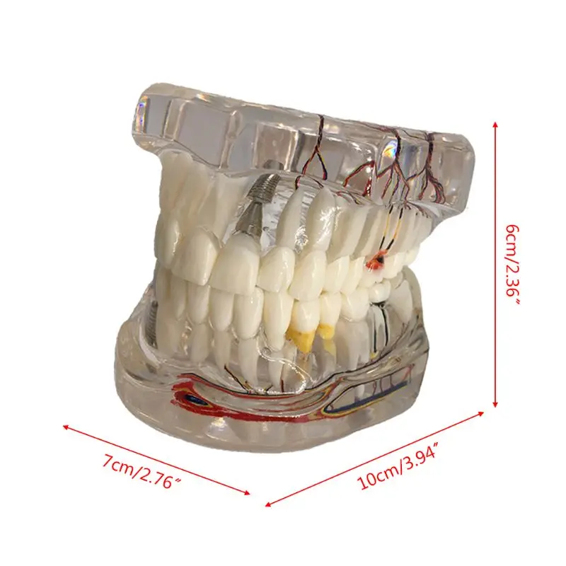 Стоматологическая модель имплантата зубов с реставрационным мостом зубной Стоматолог для медицинских исследований