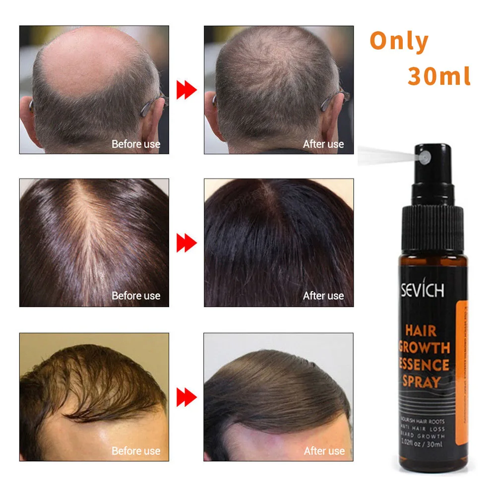 30ml Hair Growth Essence Oil Spray for Hair Regrowth Oil Anti Hair Loss  Hair Growth Serum liquid Hair Loss Treatment Hair Tonic - AliExpress Beauty  & Health