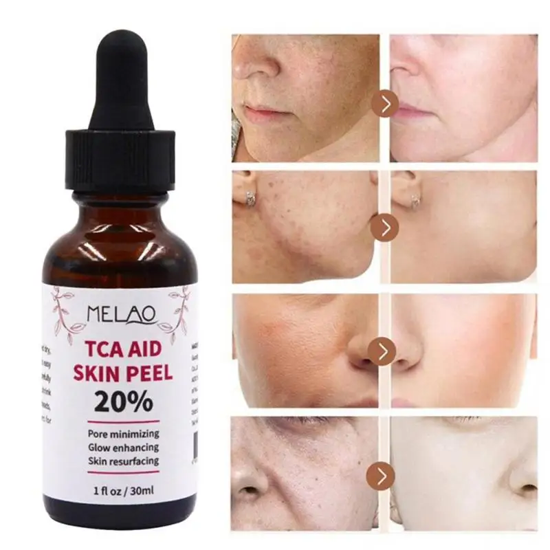 H52e9610aa3d74e60acd2b5ec263adce9b 30ml Trichloroaectic Acid 20% Skin Peel Pore Minizing Wrinkles Spots Skin Care Face Serum