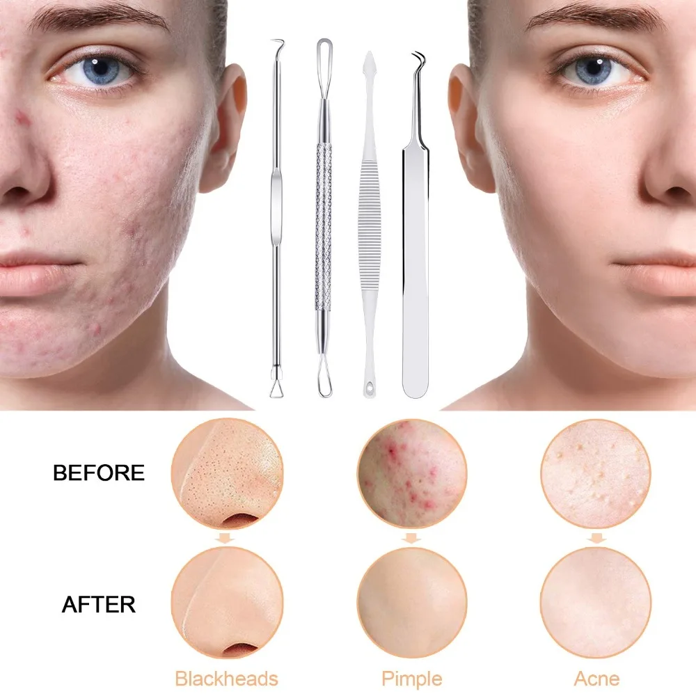 Blackhead Remover Pimple Popper Tool Kit 5