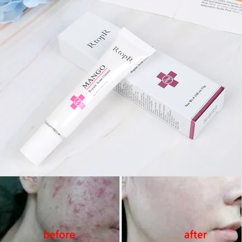 

Anti Spots Acne Treatment Scar Blackhead Cream Mango Repair Acne Cream Shrink Pores Whitening Moisturizing Face Skin Care