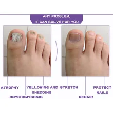 10 мл Лечение грибка ногтей против грибковых ногтей, уход за ногтями, эфирное масло лаванды, высокое качество