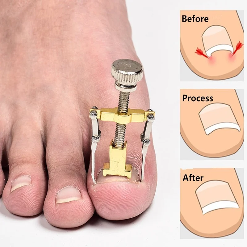 Ingrown Toenail Correction Pedicure Tool Paronychia Toe Nail Treatment  Medical Manicure Clipper Fixer Recover Corrector Tool - Nail Treatments -  AliExpress