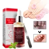 LANBENA Fungal Nail Repair Essence Serum Care Treatment Foot Nail Fungus Removal Gel Anti Infection Paronychia Onychomycosis ► Photo 2/6