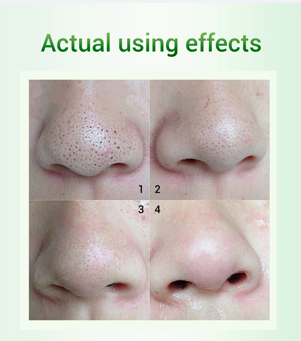 BREYLEE Acne Treatment Black Mask Blackhead Remover Shrink Pore Serum Dissolving Point Black Peeling Mask Skin Care Essence 2PCS