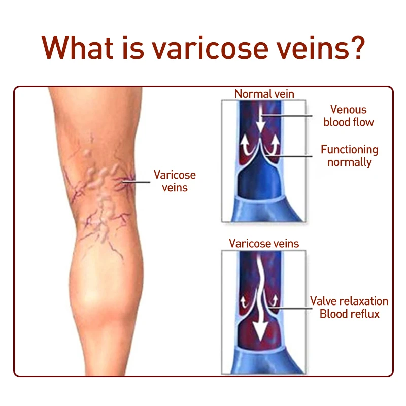 prevenirea trombozei i a varicelor tablete de la varicoza varicoza în pelvis mici