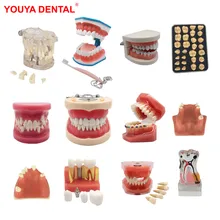 2022 vário modelo dental dentes ensino modelo estudo removível ortodôntico implante dente modelos de resina odontologia dentista material