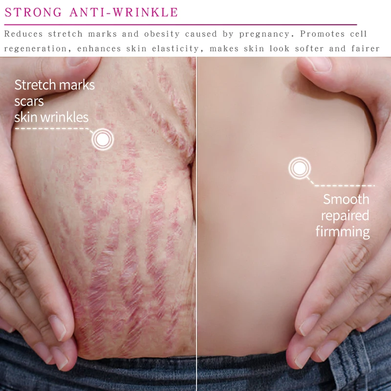 

Mango Remove Pregnancy Scars Acne Cream Stretch Marks Treatment Maternity Repair Anti-Aging Anti Winkles Firming Body Creams