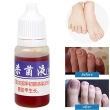 Жидкость для лечения Ногтей питает противогрибковые ногти инфекция китайские травы жидкость MH88