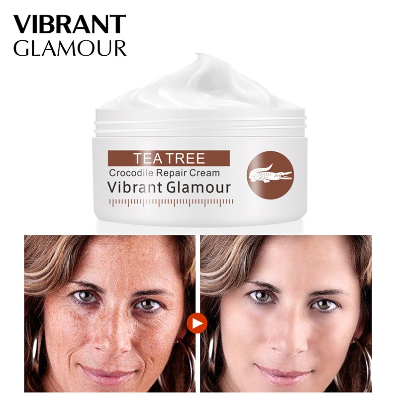 face lotion for acne scars