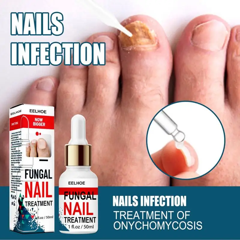 50ml Toenail Fungus Treatments Anti Fungus Nail Solution Ringworm Clear