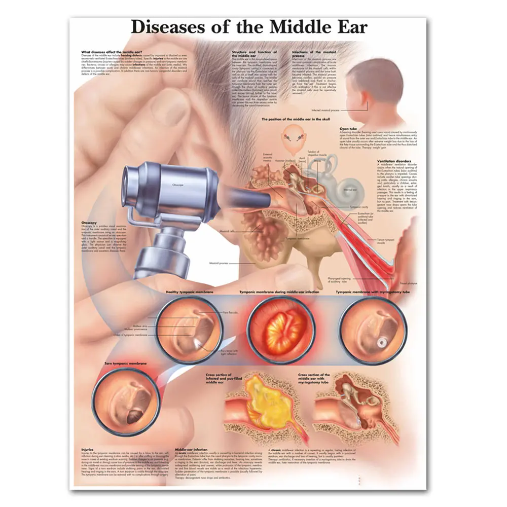 Болезни среднего уха диаграмма холст с печатью постера живопись настенные картины для медицинского образования доктора офис класс