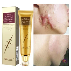 Acne Scar Cream Remove Stretch Marks Facial Gel Cream Body Skin Cream Aloe Vera Gel Whitening Cream Acne Cream and Scar Cream
