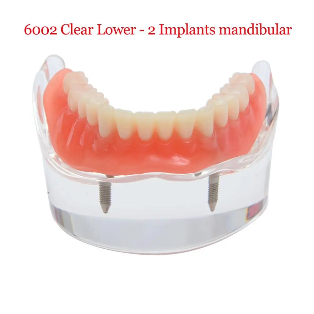 1 шт., зубной имплантат, модель зубов, восстановление протезов, прозрачный 6001, верхний 6003, нижний 6002, нижний имплантатный/нижнечелюстный - Цвет: 6002  Lower 2