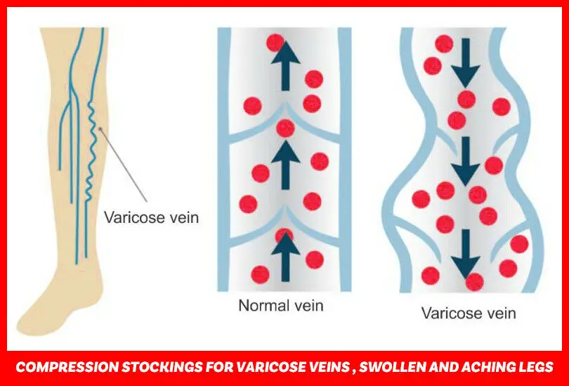 Varcoh Compression Stockings for Varicose Veins, Swollen And Aching legs.