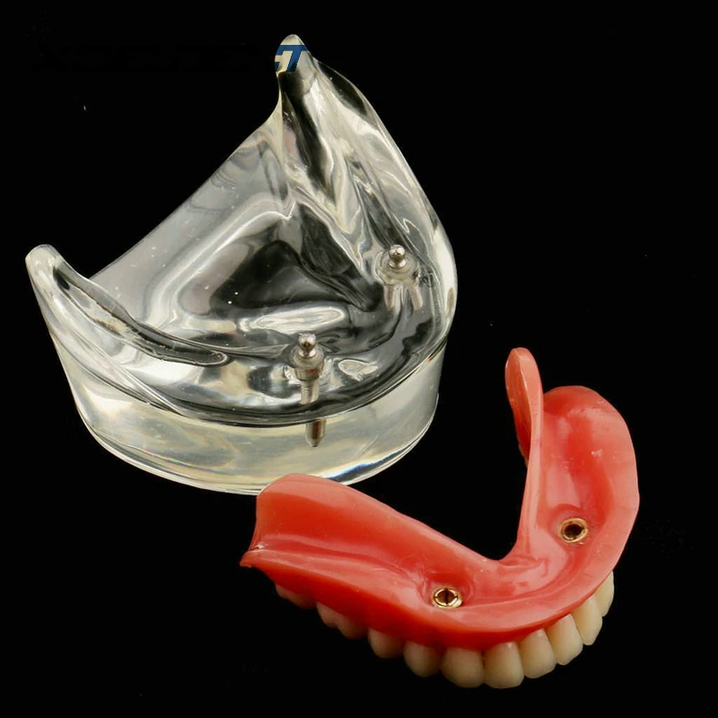 1 шт. зубная модель нижней челюсти с имплантатом реставрация зубной протез внутренняя нижняя челюсть для медицинского обучения