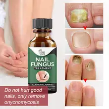 

10ml Fast Nail Fungal Treatments Nail Repair Essences Serum Care Toe Foot Nail Fungus Removal Gel Paronychia Onychomycosis