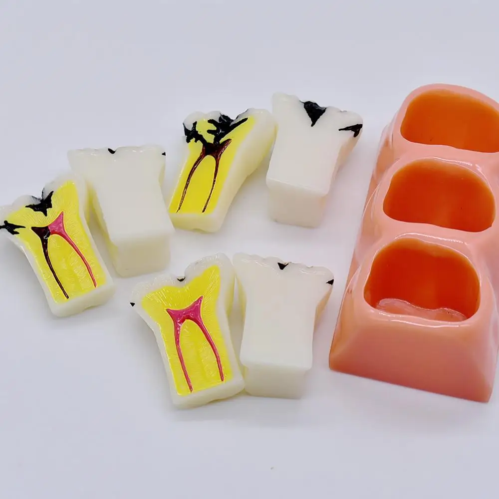  Dental teaching Model patien communication Dissected Caries Model Caries Decomposition Model Oral D - 4000402181013